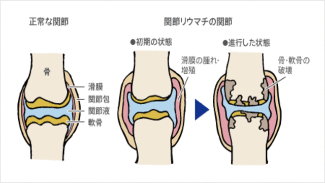 膝関節イラスト、正常とリウマチ進行状態